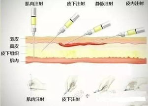 各种注射法的英文缩写图片