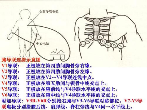 心电图位置顺序图片