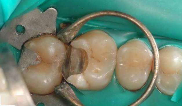 镶牙的过程图解镶牙是怎么镶的图片
