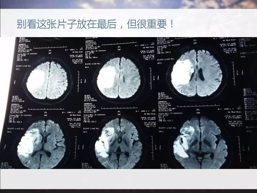 檢查所見: 右側額葉可見條片狀t1略低 t2高信號影,右側頂葉白質可見班