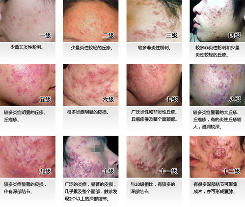痘痘有几种类型图片图片