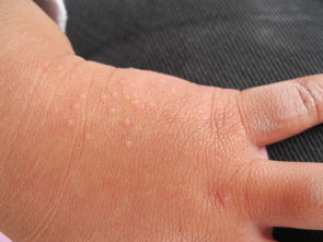 冬天手背上起小疙瘩,很痒往往是发生在手背部的湿疹,或者是过敏性皮炎