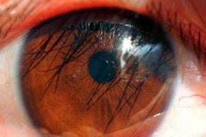瞳孔放大意味着什么脑出血瞳孔放大意味着什么