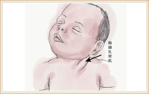六个月宝宝斜颈图片图片