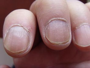 灰指甲早期症状图表现图片
