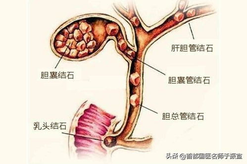 肾结石排出示意图图片