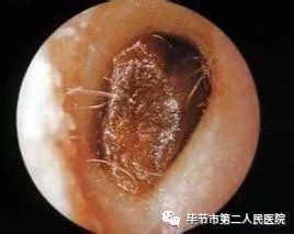 耳屎多是怎麼回事,寶寶耳朵裡面耳屎多怎麼辦_競價網