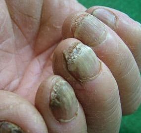 灰指甲是什么症状图片