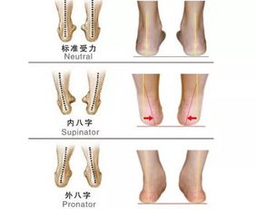 外八字脚怎么矫正可以w坐吗一岁宝宝外八字脚怎么矫正