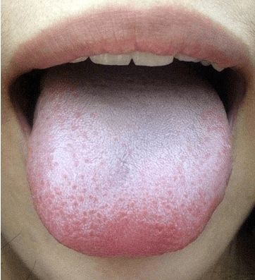 通过看舌头可以了解身体的健康状况,预知部分疾病:1,舌尖红,苔黄如果