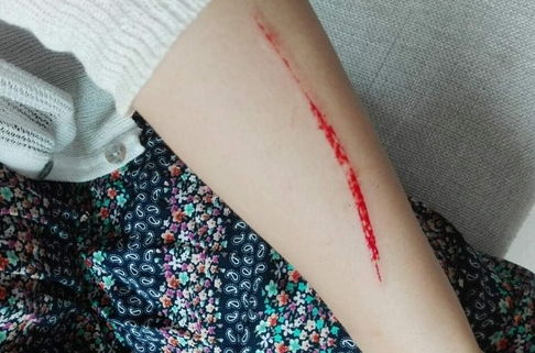 女生手臂划出血的图片图片