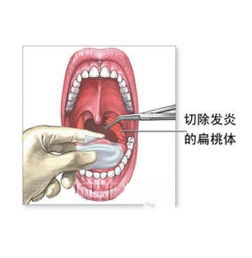 兒童扁桃體切除對身體有影響嗎