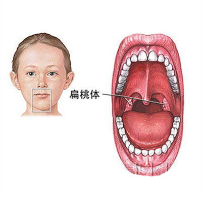 做一個扁桃體切除手術多少錢