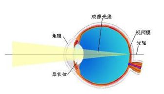 散光和近视的区别哪个更严重