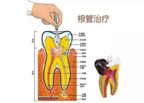 抽牙神经后一定要做牙套吗