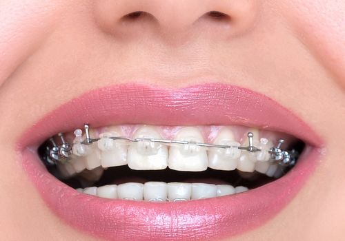 矫正牙齿拔牙是一次性拔四颗还是分两次?