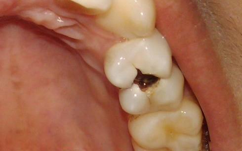 虫牙里面真的有虫吗图片,牙齿里取出活虫是真的吗