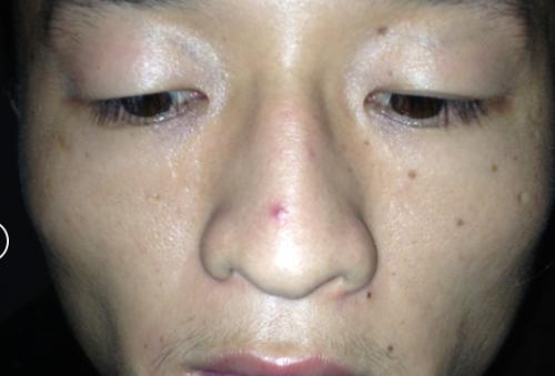 鼻子红如何快速消除祛除红鼻头的有效方法:1,中医认为,鼻子发红是因