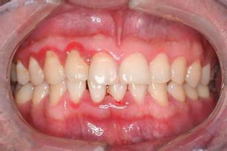 牙龈萎缩的症状有哪些?